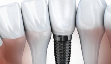 implante dental estudios