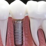 implante dental instalado